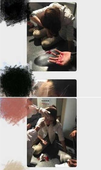 娱乐圈劳模！戚薇缝完针后立即开工，素颜出镜伤痕明显