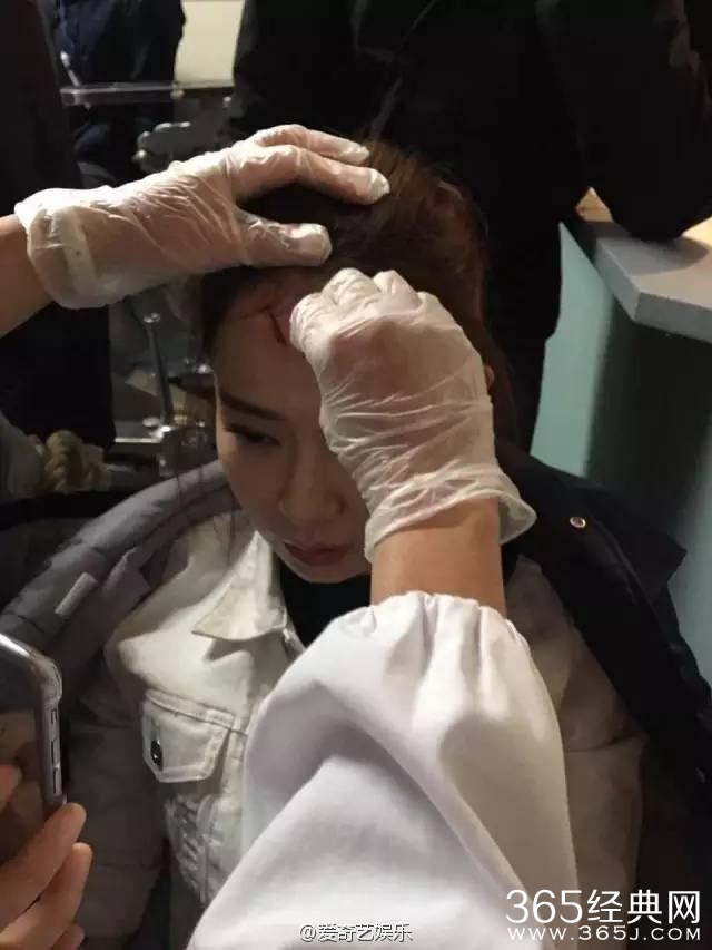 娱乐圈劳模！戚薇缝完针后立即开工，素颜出镜伤痕明显