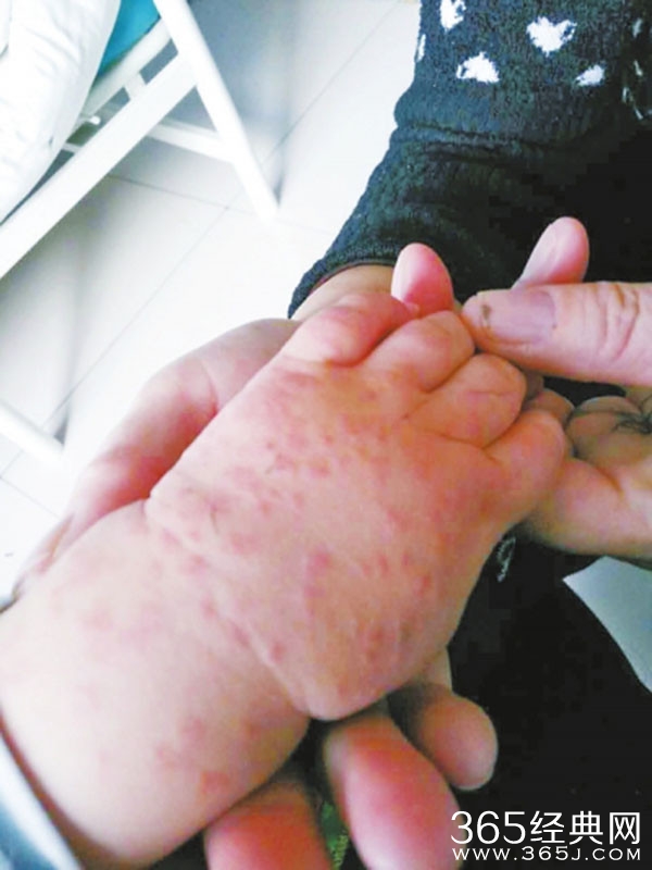 河南一所医院给1岁娃输禁用药致严重过敏，此药曾有致死案例