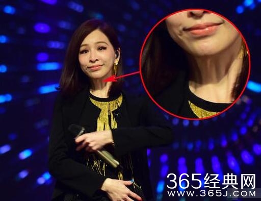 王心凌整容前后对比照片 表情僵硬颈纹明显