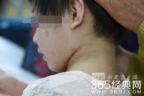 5岁女童遭继母哥哥虐待 9根肋骨骨折