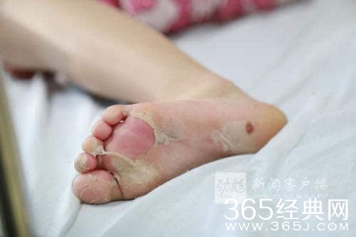 5岁女童遭继母哥哥虐待 9根肋骨骨折