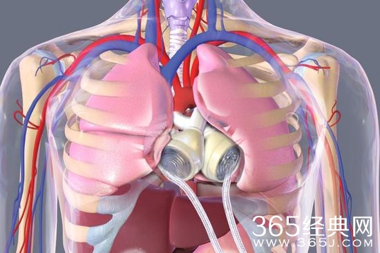 不再等待移植 永久性全人造心脏即将服役