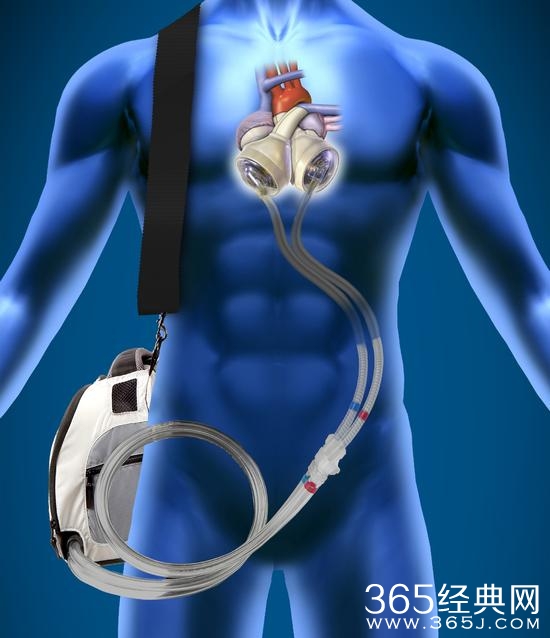 不再等待移植 永久性全人造心脏即将服役