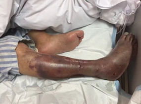 医生劝患者截肢保命 家人表示可以死但不能死无全尸