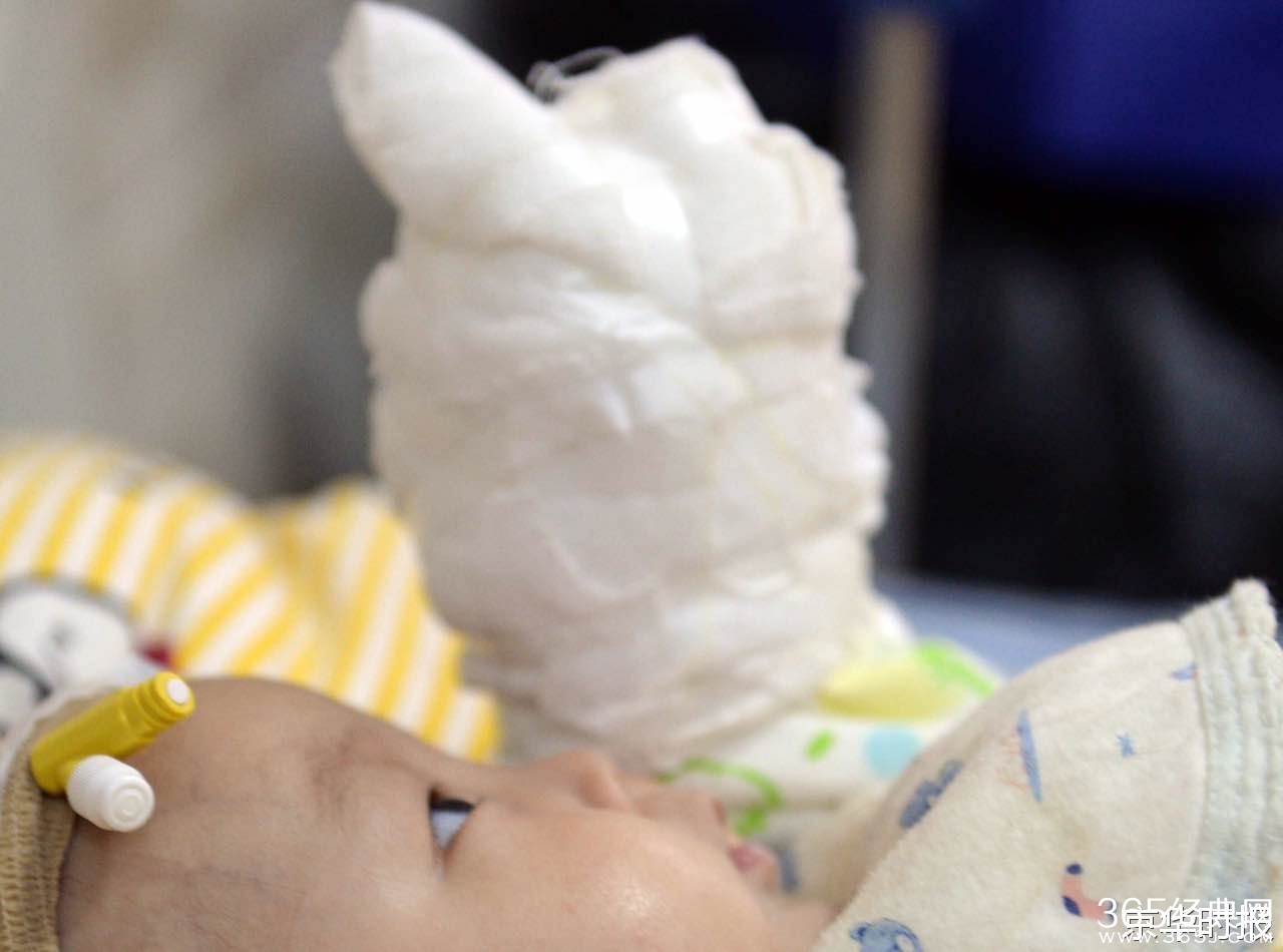 4月大男婴与狗同睡地铺 被咬掉两根手指