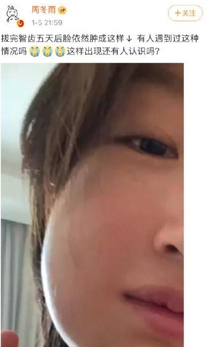 周冬雨戴口罩领奖 只因拔完智齿肿成“小包子”