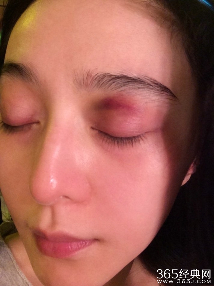 范冰冰遭木棍打伤眉骨 李晨撞树摔马