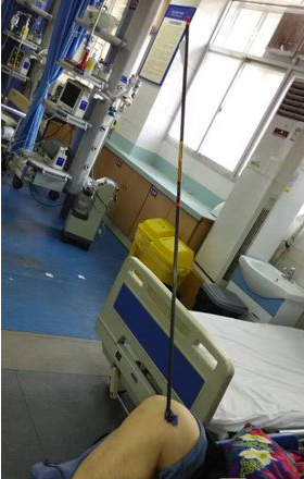 长沙男子晾衣时膝盖中箭