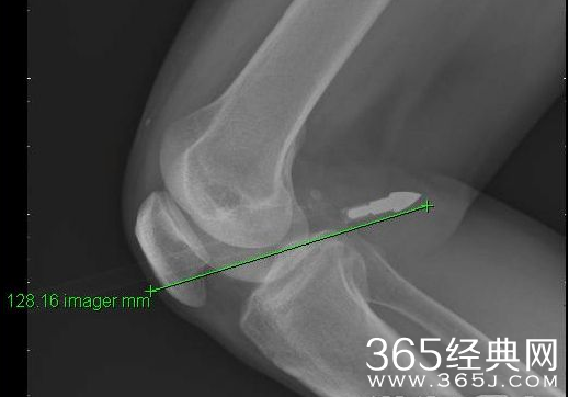 长沙男子晾衣时膝盖中箭