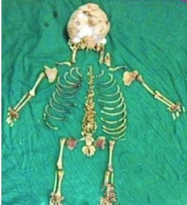 印度一60岁老太太宫外孕36年 腹中胎儿只留下一副骸骨