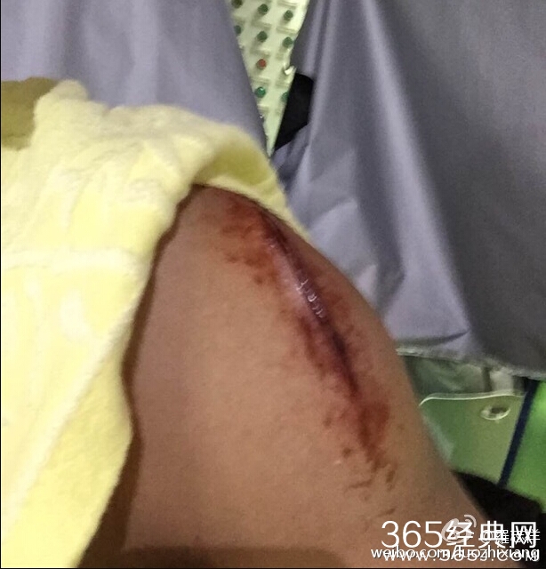 罗志祥受伤了是真的么_罗志祥微博晒左手臂受伤照片_罗志祥到底有没有受伤