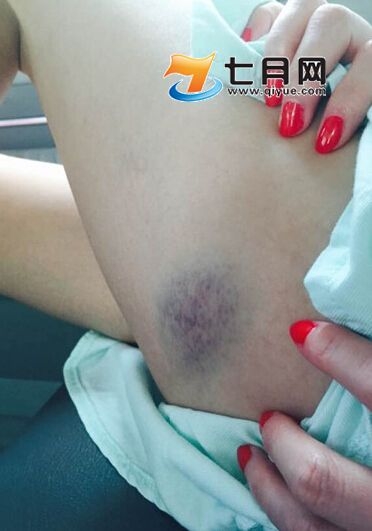 姚笛大张伟录节目牛车失控受伤照片 膝盖渗血臀部淤青