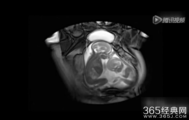 实拍双胞胎为争地盘在妈咪子宫里打架视频在线观看_365经典网