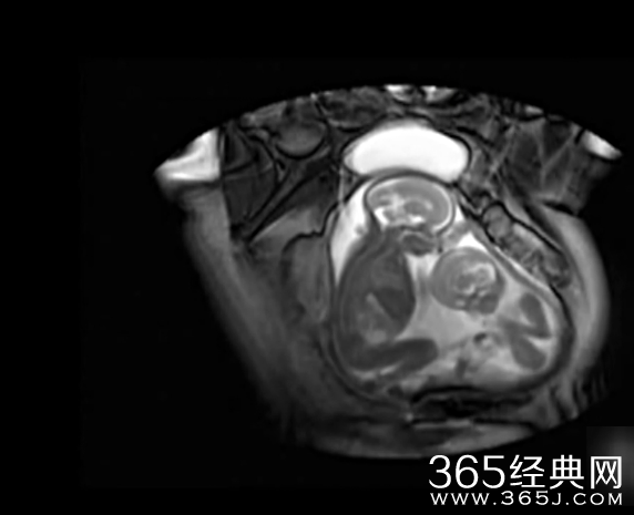 实拍双胞胎为争地盘在妈咪子宫里打架视频在线观看_365经典网