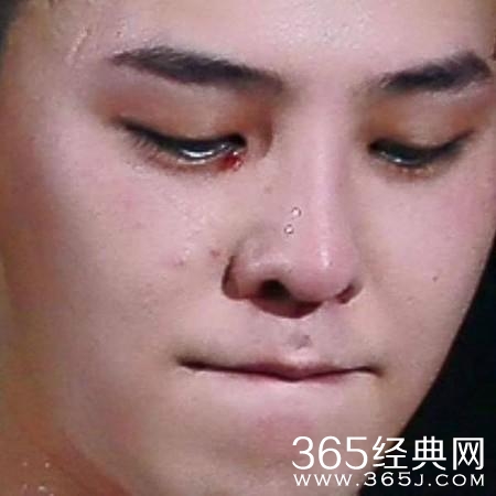 权志龙右眼眼角为什么受伤原因揭秘 权志龙右眼眼角受伤照片