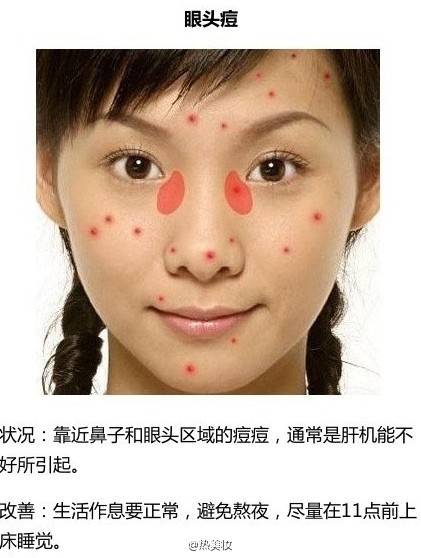 脸上长痘该怎么办？