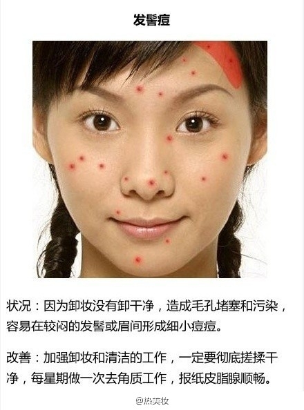 脸上长痘该怎么办？