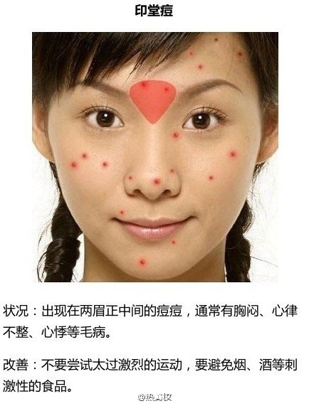 脸上长痘该怎么办？