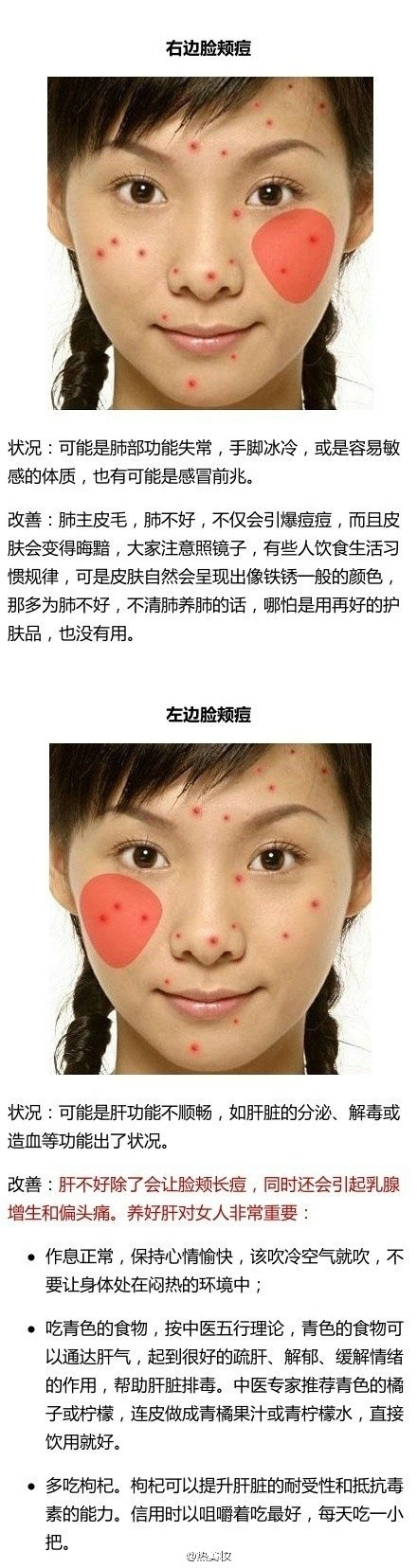 脸上长痘该怎么办？