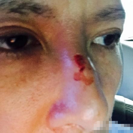 甄子丹拍叶问3鼻子受伤 调侃不是泰森咬的