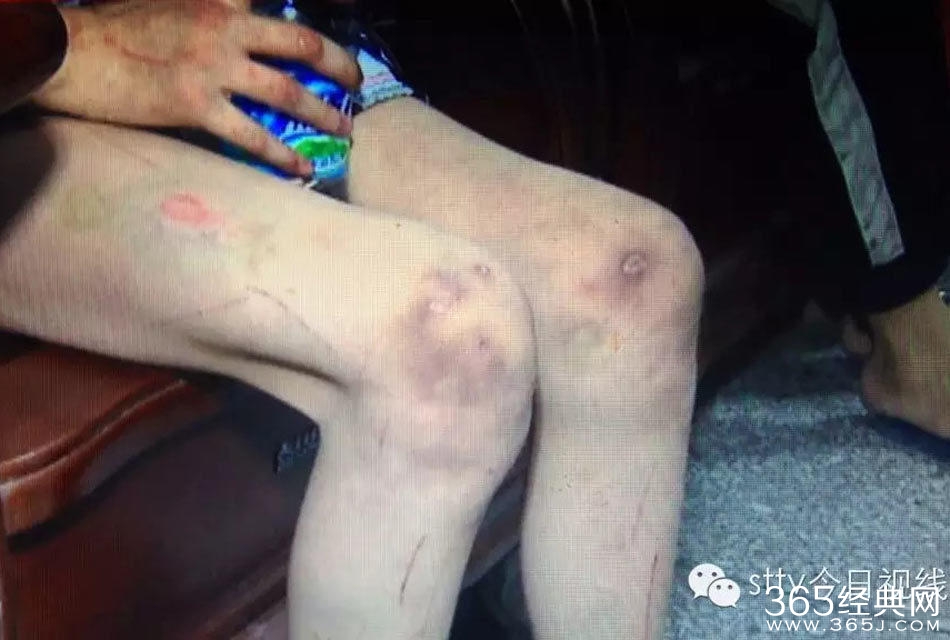 姐弟长期遭生父继母虐打不敢报警  称“不然会死的很惨”