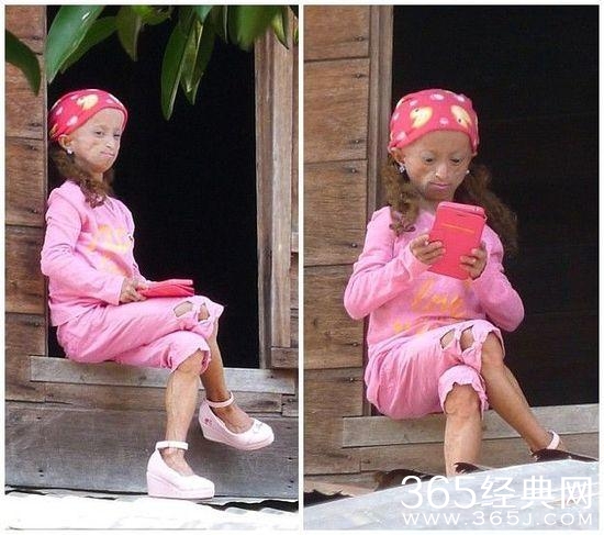 全球最老的早衰症患者是谁多大