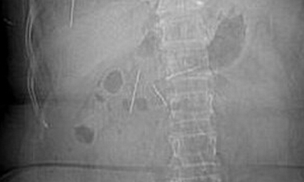 老太治腹痛吞针 险些丢了性命