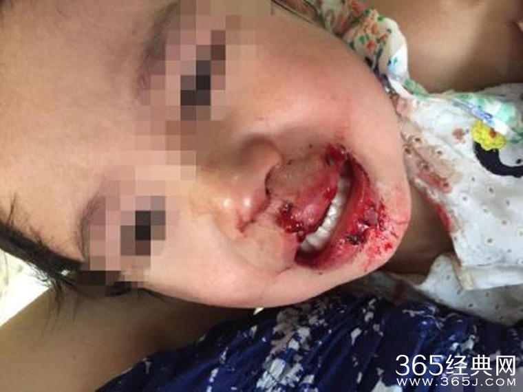 狗强吻女童致唇裂 嘴巴鲜血直流恐怖
