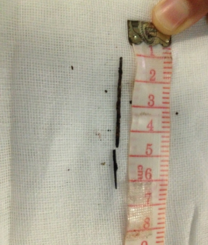 女孩胸腔取出钢针 距离动脉仅1厘米