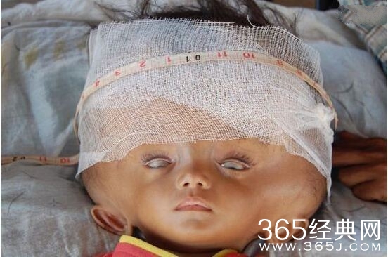 女婴惊似外星人 医生束手无策