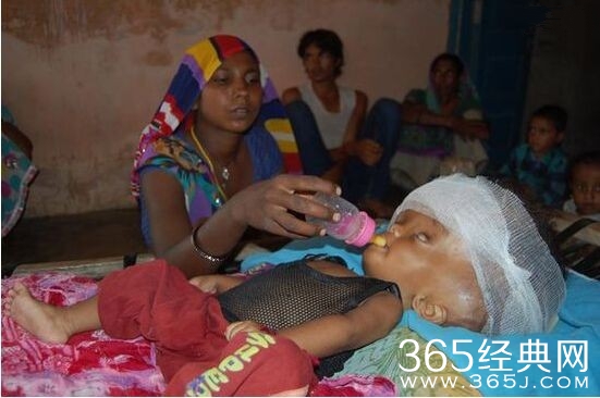 女婴惊似外星人 医生束手无策