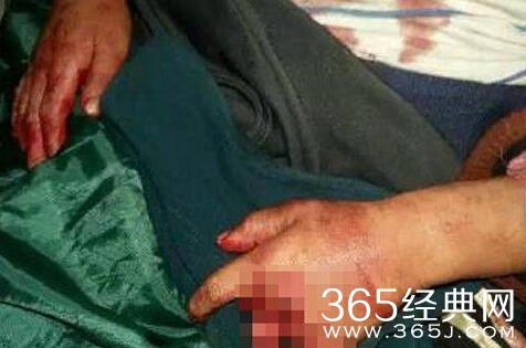 被女邻居砍断手指生殖器的6岁男童现在伤势怎么样了 嫌男童吵闹