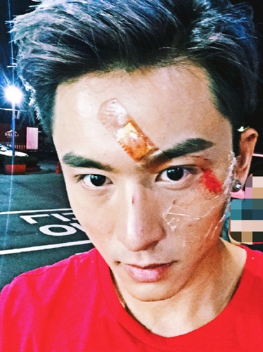 中韩梦之队张哲瀚受伤毁容吗？张哲瀚为什么会受伤毁容？