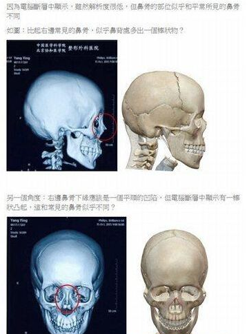 Angelababy整容鉴定作假被识破 鼻骨棒状物露馅
