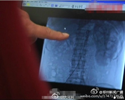 做手术右肾神秘丢失 警方不予立案调查