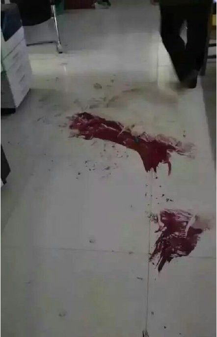 河南一年轻女医生被砍7刀 目前在ICU救治