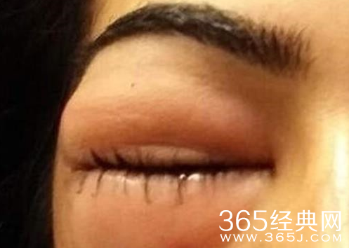 擤鼻涕用力险致盲 女子眼睛成金鱼眼擤鼻涕需谨慎