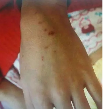 金华9岁女生被男同桌扎64个针眼