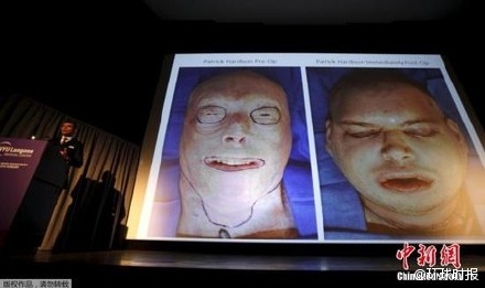 世界最高难度换脸手术 美国消防员帕特里克·哈迪森换脸手术全过程