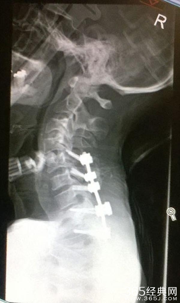 摔断112根骨生还 大难不死必有后福