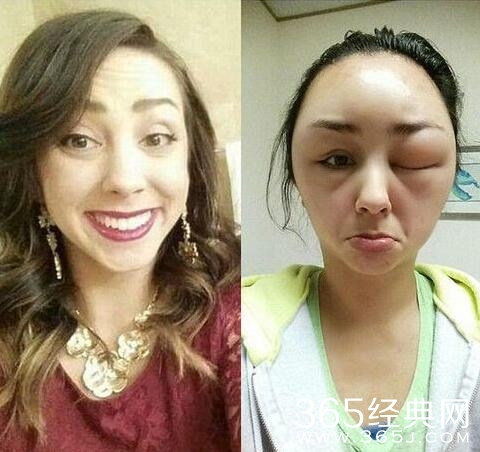 美女脸肿成外星人 都是染发惹的祸