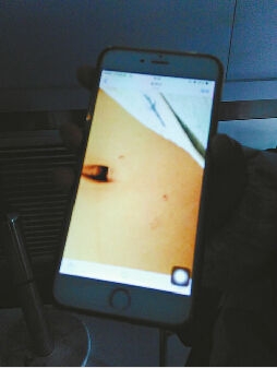 3岁娃身上现针眼般伤痕