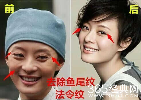 孙俪自曝整过容