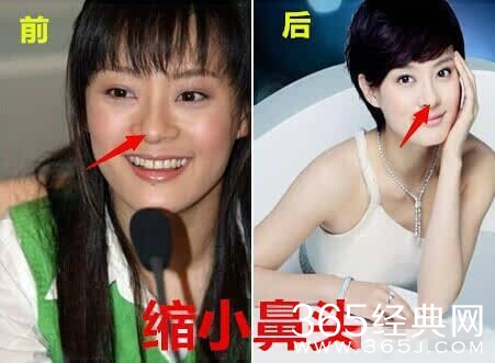 孙俪自曝整过容