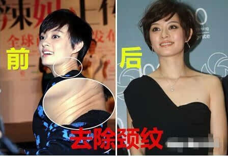 孙俪自曝整过容