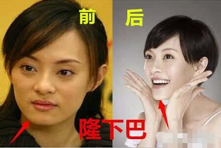 孙俪自曝整过容