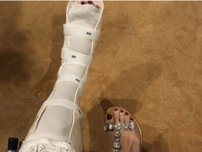 白百何腿骨折严重吗