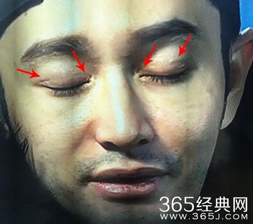 《旋风孝子》黄晓明割双眼皮疤痕暴露