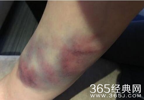 何润东右手受伤打石膏 女友喂食贴身伺候